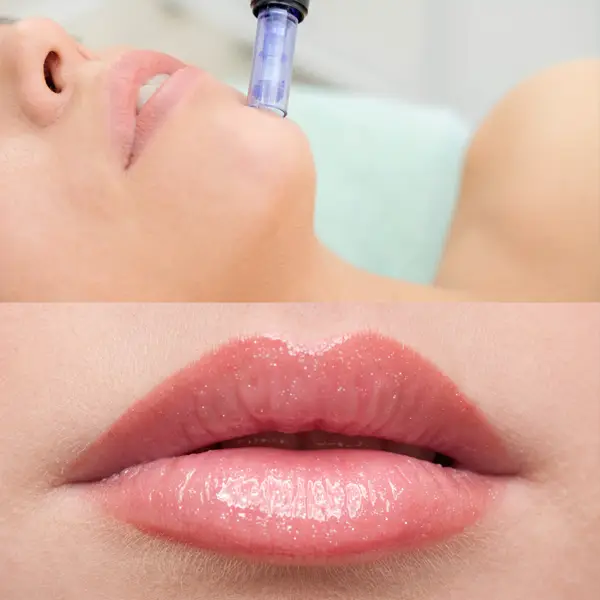 Hidra lips